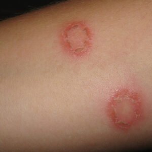 Dermatophytosis / Ringworm / Tinea Ayurvedic Natural Treatment