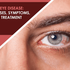 Dry Eye Syndrome Ayurvedic Herbal Treatment