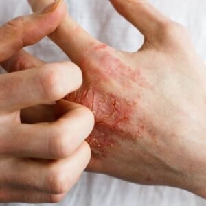 Eczema Ayurvedic Herbal Treatment