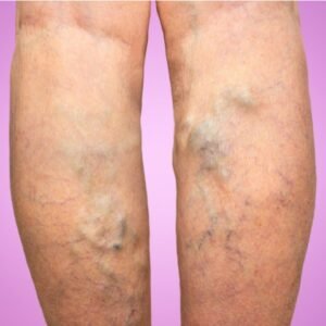 Varicose veins Ayurvedic Herbal Remedies