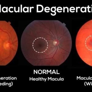 Macular Degeneration Natural Ayurvedic Treatment