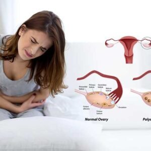 PCOS Polycystic ovarian syndrome Ayurvedic Herbal Treatment