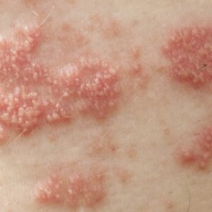 Shingles or Herpes Zoster Ayurvedic Natural Treatment