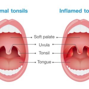 Tonsillitis Ayurvedic Herbal Treatment