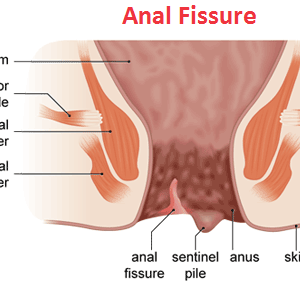 Anal Fissures/ fissure-in-ano Ayurvedic Herbal Treatment