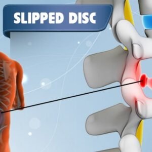 Slipped Disc Herniated Disc Ayurvedic Herbal Alternative Treatment