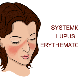 SLE Systemic Lupus Erythematosus Ayurvedic Natural Treatment