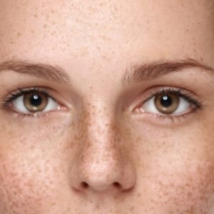 Freckles, Melasma and other Hyper pigmentation problems Ayurvedic Treatment