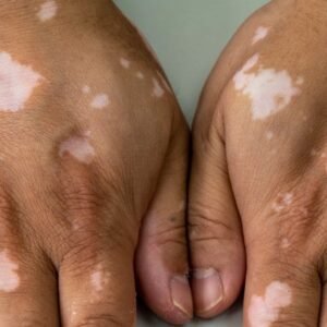 Vitiligo Leucoderma Ayurvedic Herbal Remedies