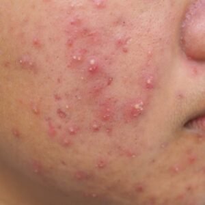 Acne Ayurvedic Herbal Treatment