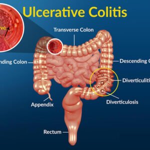 Ulcerative Colitis and Crohns Disease Natural Ayurvedic Treatment